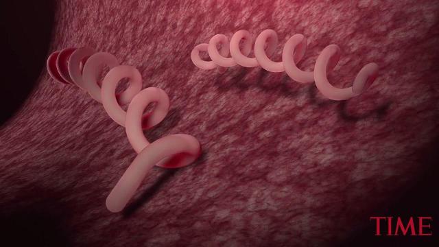Syphilis cases in California drive a record-setting year for STIs nationwide – Desert Sun